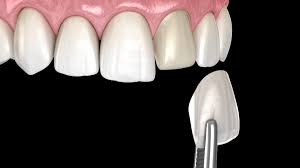 Composite veneer