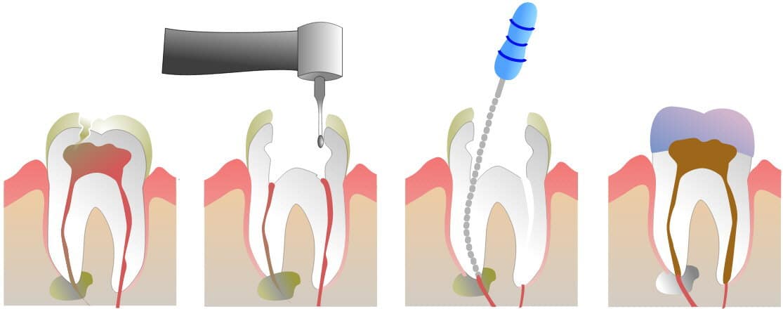 Root Canal Treatment
